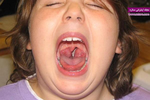 لوزه سوم چیست؟ درمان لوزه سوم در طب سنتی و عمل لوزه لوزه سوم چیست؟ درمان لوزه سوم در طب سنتی و عمل لوزه