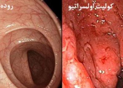 منشأ بیماری التهاب روده چیست؟